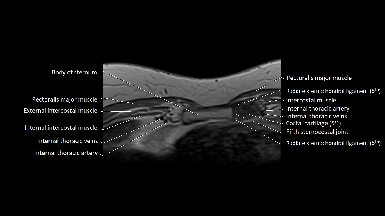 MRI sternum and sternoclavicular joint labeled axial anatomy image 28.webp